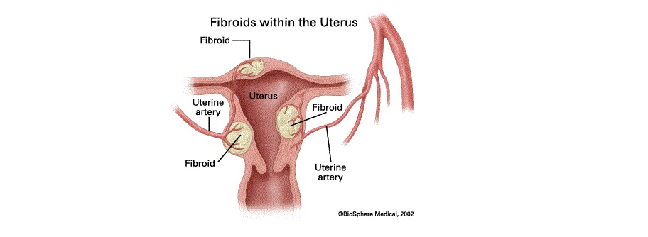 What Is Uterine Fibroids And How Is It Treated